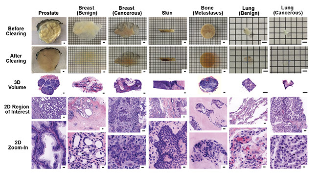Figure 7. Images of 3D samples with digital false coloring to mimic the appearance of H&E stains of traditional 2D samples. The digital 3D images allow for 2D zoom-in on regions of particular interest, with higher resolution than traditional 2D slide sample analysis. Samples include biopsies of prostate, breast (benign and cancerous), skin, bone (metastases), and lung (benign and cancerous). Scale bars: 2 mm (first three rows, 3D), 100 µm (fourth row, 2D region of interest), and 10 µm (bottom row, 2D zoom-in). Courtesy of A. Glaser/University of Washington Molecular Biophotonics Laboratory.