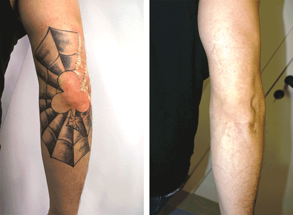 Clean Slate Laser on Twitter We often get asked about the safety and  effectiveness of tattoo removal on medium or dark skin Our unique approach  has given us a long track record