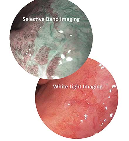 Selective band imaging enhances the visibility of high-grade dysplasia in Barrett’s esophagus.