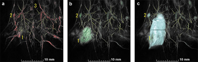 Photoacoustic and optical images of the ventrodorsal view of a mouse specimen: 532 nm (yellow, skin level) + 890 nm (red, deep anatomy) (a); 532 nm (yellow, skin level) + 780 nm (green, ICG detecting) (b) and 532 nm (yellow, skin level) + 780 nm (green, ICG detecting) + FMT (blue, 780-nm excitation) (c). Injection site, right subiliac lymph node drainage from injection site, and vertebrae (for reference) labeled 1, 2, and 3, respectively. Courtesy of the Ultrasound Imaging and Therapeutics Research Laboratory at Georgia Tech.