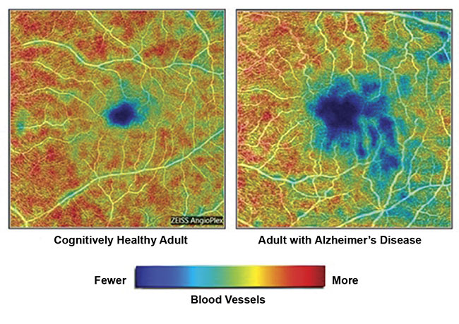 Figure 2. Images from a Duke University study show the loss of blood vessels in the retina of an adult with AD (right) versus an adult with a healthy brain. Courtesy of Duke Eye Center. 