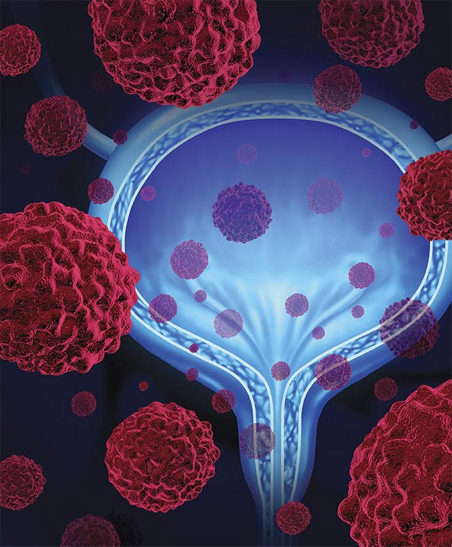 A conceptual image of a bladder with microscopic malignant cells spreading throughout the human body. Courtesy of Lightspring/Shutterstock.com.