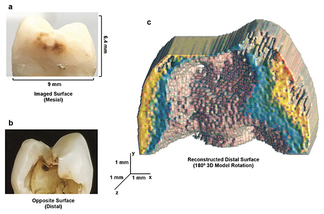 Figure 2. eTC-PCT 3D reconstruction of advanced dental decay. Mesial and distal surfaces, respectively, of a tooth with a large, cavity-like, carious lesion only visible from the distal surface (a, b). The 180° rotation of the 3D thermophotonic image taken from the mesial (outer) surface, showing the reconstructed distal face (c). The data clearly demonstrates the eTC-PCT structural modeling and boundary delineation capability. Courtesy of University of Toronto.