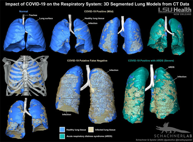 An LSU Health New Orleans radiologist and evolutionary anatomist demonstrate that 3D models are a promising method for visually evaluating the distribution of COVID-19-related infection in the respiratory system. Courtesy of LSU Health New Orleans.