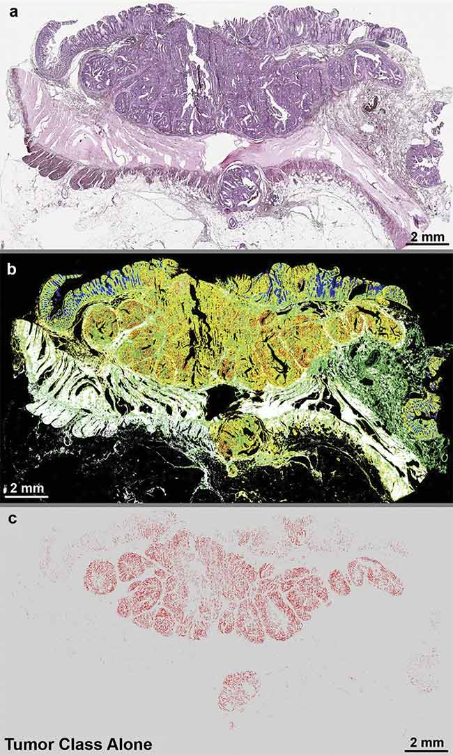 Quantum cascade laser (QCL)-based IR imaging of whole slice colorectal cancer tissue thin sections. The tissue was stained with hematoxylin and eosin (H&E) (a), and label-free images were taken using a QCL-IR microscope (b, c). The H&E image shows the structure of the diseased colon wall (a), while (b) highlights the classes of tissue and (c) highlights the tumor alone. Adapted with permission from Reference 1/CC BY 4.0.