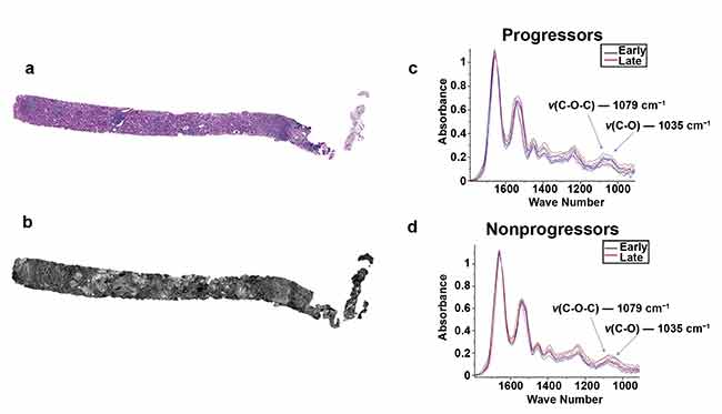 Two serial sections of tissue were placed on a glass slide and an IR-compatible substrate. One section was stained with periodic acid-Schiff (a) while the other unstained section was imaged using QCL-based IR imaging (b). A region of interest was located and biochemical data was collected for progressor (c) and nonprogressor (d) cohorts for both early- and late-time-point biopsies. Adapted with permission from Reference 2/CC BY 4.0.