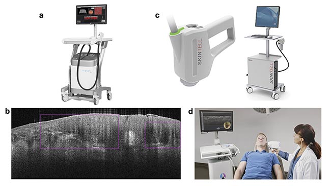 Figure 1. Commercial systems for dermatology using OCT. The VivoSight from Michelson Diagnostics (a). The image marker for basal cell carcinoma found by AI and the VivoSight (b). Courtesy of Michelson Diagnostics. The Skintell from Agfa (c). Courtesy of Schlagheck Design GmbH. The deepLive from Damae Medical in use (d). Courtesy of Damae Medical.