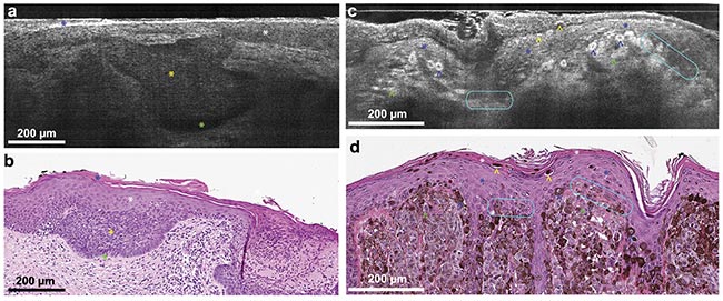 Figure 2. Line-field confocal (LC)-OCT B-scan images of superficial basal cell carcinoma (a) and corresponding hematoxylin and eosin (H&E) stain (b). Blue star: stratum corneum; white star: epidermis; yellow star: clusters of tumor cells that are poorly reflecting in the LC-OCT image; green star: cleft between the tumor islands and the dermis. LC-OCT B-scan images of melanoma (c) and corresponding H&E stain (d). White star: stratum corneum; blue star: epidermis; blue arrowhead: pagetoid spread (epidermal invasion) of epithelial tumor cells; yellow arrowhead: intracorneal tumor cells in the process of being eliminated; green arrowhead: dermal clusters of melanocytic tumor cells; turquoise circles: partial disruption of the dermal-epidermal junction. Adapted with permission from Reference 3.