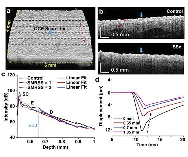 Figure 3. OCT/optical coherence elastography (OCE) imaging of control and sclerotic plaques. A 3D OCT scan co-aligned with OCE scans (black dashed lines, a) and OCT images of typical control and Systemic Sclerosis (SSc) subjects (b), where the air-pulse excitations are indicated by the blue arrows. An example of an OCT A-line with linear fits to obtain the OCT spectral slope in the dermis (c). Temporal displacement profiles of the air-pulse-induced elastic wave propagation, and the black dashed arrow demonstrates the propagation of the elastic wave (d). SMRSS: site-specific modified Rodnan Skin Score. Adapted with permission from Reference 5.