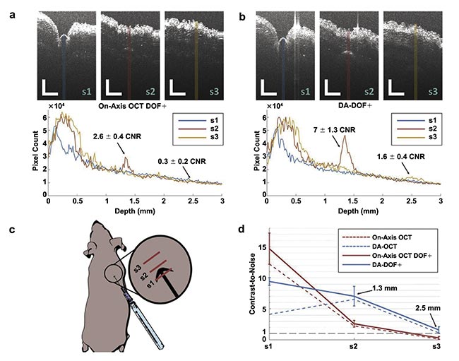 Figure 4. Dual-axis (DA) OCT enables enhanced visualization of a subcutaneous 28-gauge pen needle penetrating mouse skin using two imaging modes: on-axis OCT with enhanced depth of focus (DOF+) (a), and DA-DOF+ (b). Averaged A-line profiles (N = 10) for each image correspond to colored regions of interest shown. OCT scanning orientation (red lines, c). Contrast-to-noise (CNR) analysis for on-axis OCT with DOF+ (red) and DA-DOF+ (blue) concerning sample/needle penetration (d). Red and blue dashed lines represent on-axis OCT and DA-OCT using a fixed focal zone centered at f = 0.75 mm, respectively. The gray line represents CNR = 1. Scale bars: 1 mm. Adapted with permission from Reference 7.