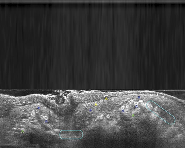 A line-field confocal optical coherence tomography (LC-OCT) B-scan image of melanoma. Adapted with permission from Reference 3.