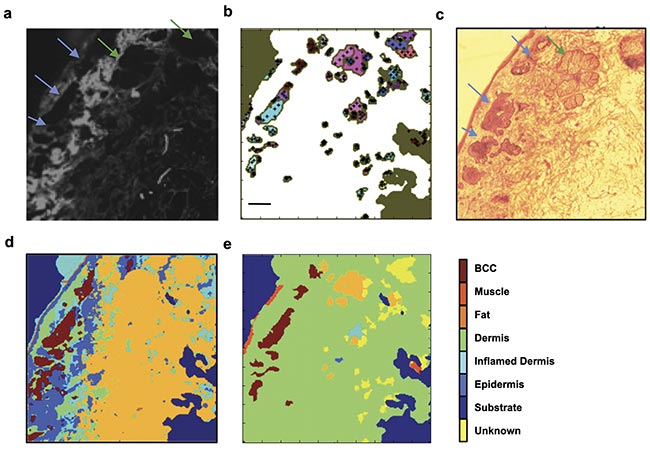 Figure 1. Selective sampling with Raman spectroscopy guided by autofluorescence confocal imaging. The tissue autofluorescence confocal image shows the distribution of collagen on the skin specimen (a); the automated image segmentation identifies regions with low autofluorescence signal and distributes sampling points in the region (black crosses, b); an H&E section showing the location of the tumor (blue arrows) and a sebaceous unit (green arrow, c); a diagnosis obtained by 200 × 200 raster-scanning Raman spectroscopy (40,000 spectra, d); a diagnosis obtained by combining autofluorescence imaging and Raman spectroscopy (350 spectra, e). The tumor is identified in the same location as in the higher-resolution raster scan and the H&E section. Scale bars: 0.5 mm. Adapted with permission from Reference 3.