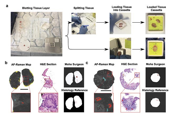 Figure 4. Tissue processing for autofluorescence-Raman measurements and representative split and “full-face” Mohs layers. Specimens are blotted to remove superficial blood and then placed directly in the cassette or split into several pieces and then placed in the cassette. Before closing the cassette, colored marks are made on the cassette window to preserve tissue orientation (a). The result for a “full-face” layer (b) and the result for a split layer (c). Red regions show basal cell carcinoma (BCC), blue regions show poor tissue-cassette window contact, and yellow regions indicate excessive blood. The BCC detections are confirmed by the hematoxylin and eosin (H&E) sections and the histology reference report. The Mohs surgeon report is also in concordance with the reference. Scalebar: 5 mm. AF: autofluorescence. Courtesy of the University of Nottingham.