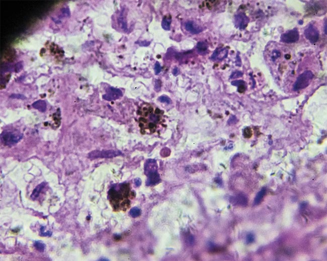 A melanoma biopsy from different regions under a microscope. Courtesy of iStock.com/jxfzsy.