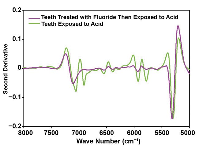 Figure 3. A second derivative of absorbance spectra of synthetic hydroxyapatite (HAp) treated with 22.6 mg/L fluoride and then exposed to an acid at pH 4.0 compared with HAp exposed to acid without a fluoride pretreatment (top); and second derivative of absorbance spectra of teeth treated with 22.6 mg/L fluoride and then exposed to an acid at pH 4.0 compared with teeth exposed to acid without a fluoride pretreatment (bottom). Courtesy of Liza Pretorius/Central Queensland University.