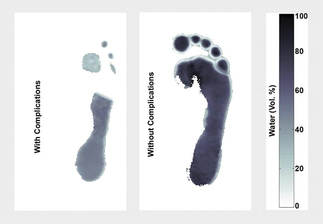 Figure 4. Exemplary water mapping images of two patients with diabetes with diabetic foot complications (left) and without complications (right). Courtesy of E. Castro-Camus.