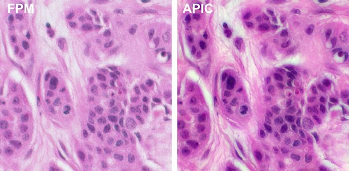 A stained breast cancer sample was imaged using red, green, and blue LEDs. A new computational microscopy technique developed at Caltech, called APIC, was used to reconstruct the detailed color image shown on the right. The image shows even higher resolution than the image on the left, which was obtained using FPM, a widely-used microscopy technique. Courtesy of Caltech.