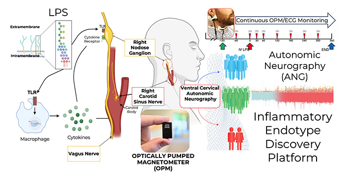 Left: Subjects received lipopolysaccharide (LPS) injections to induce temporary hyperinflammation, mimicking a blood infection. Middle: Small, noninvasive devices called optically pumped magnetometers (OPMs) recorded autonomic neurography (ANG) activity from neural structures (right vagus nerve, right nodose ganglion, and right carotid sinus nerve) in the human neck in response to the perceived inflammation. Right: Neural signals categorized subjects’ inflammatory responses to LPS injections as high or low, providing a real-time, wearable bioindicator of inflammation in humans. Courtesy of UC San Diego.