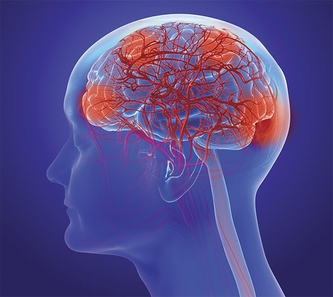 An illustration of the human brain with Alzheimer’s disease. Courtesy of iStock.com/Lars Neumann.