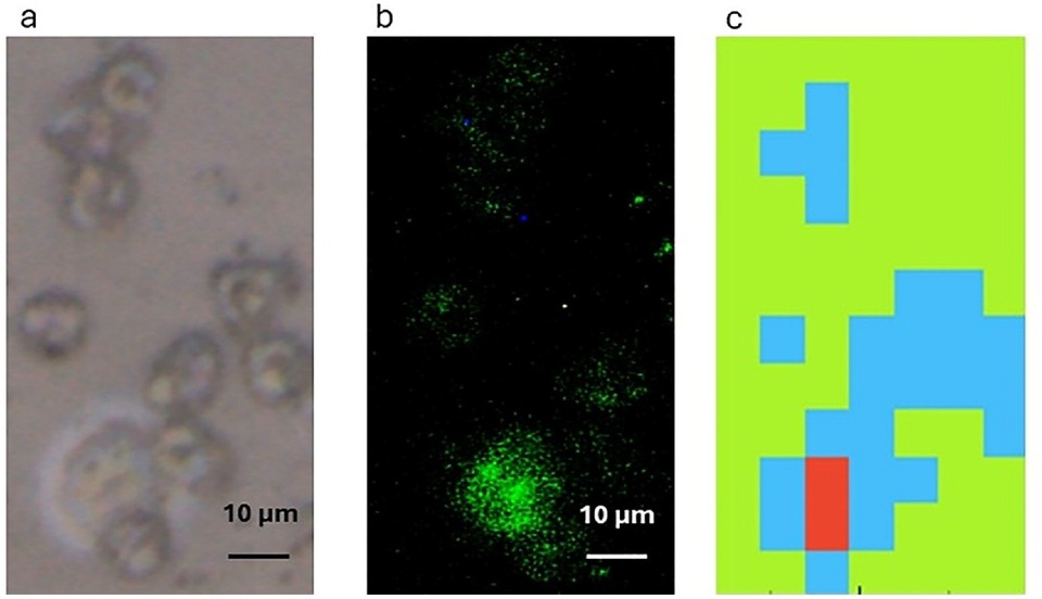 This figure shows how the technique identifies a single circulating tumor cell (CTC) in a lung cancer patient’s blood sample. The sample is first viewed under a microscope (a), and, after being tested, the cancer cell is stained (b) so the researchers can confirm it is a cancer cell. The Fourier Transform Infrared (FTIR) microspectroscopy technique produces a color-coded map (c) distinguishing the CTC (red) from surrounding blood cells (blue/green). Courtesy of Loughborough University.