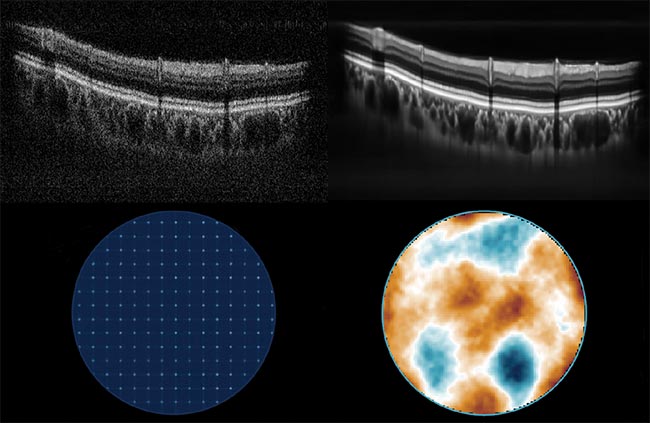 Figure 4. Imagine Optic’s use of AI pushes the limits of wavefront sensing. An image of a human retina (top images) acquired via optical coherence tomography before (top left) and after (top right) AI image denoising. AI phase reconstruction (bottom right) from a Hartmanngram raw signal (bottom left). Courtesy of Top images of the complete graphic are courtesy of Imagine Eyes and CEA. Full image courtesy of Imagine Optic.