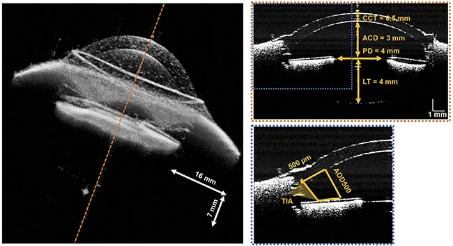 Figure 3. An OCT volume reconstructed from the average of upward and downward sweeps, showing a sample B-scan (selected at dotted orange line position) magnified at the dotted blue region of the anterior chamber of the model eye, recorded at a 1.6-MHz A-scan rate. ACD: anterior chamber depth; AOD500: the angle-opening distance at 500-µm anterior to the scleral spur; CCT: central cornea thickness; LT: lens thickness; PD: pupil diameter; TIA: trabecular-iris area. Courtesy of OCTLIGHT ApS.
