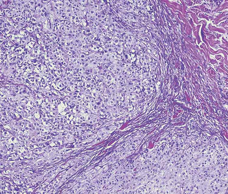 Metastatic melanoma. Courtesy of iStock.com/OGphoto