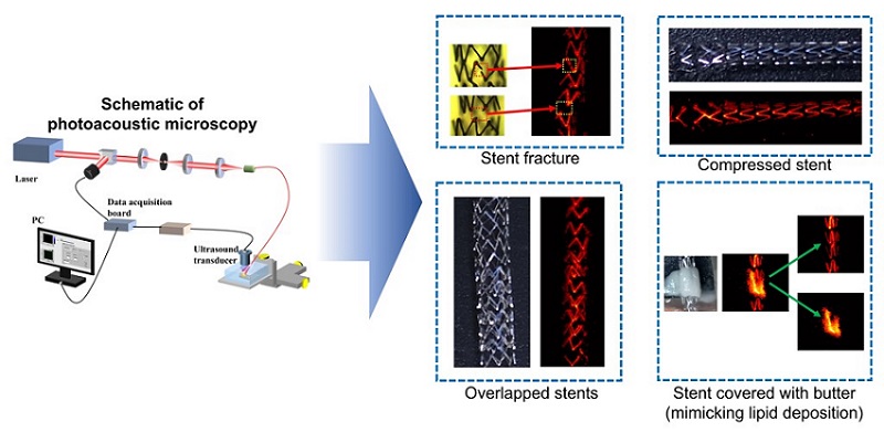 Researchers used photoacoustic microscopy to image stents through skin. They were able to visualize stents with fractures and compression, and other clinical scenarios such as overlapped stents or conditions mimicking lipid deposition. Courtesy of OPTICA.