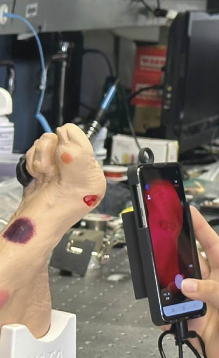 Figure 1. The smartphone oxygenation tool (SPOT) hardware with an optical module attached to the smartphone (left). The smartphone display showing camera controls and real-time diffuse reflectance signals (right). Courtesy of Florida International University.