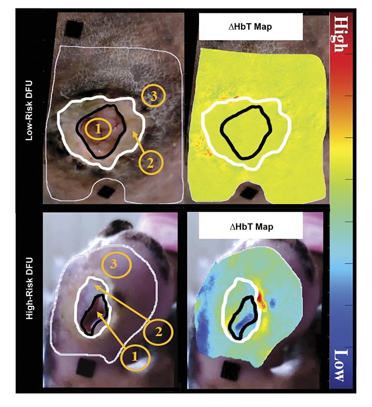 Figure 3. White light and effective total hemoglobin (HbT) maps of low-risk and high-risk diabetic foot ulcer (DFU) cases. Region 1 is the wound, region 2 is the nonepidermal peri-wound region, and region 3 is the area where tissue oxygenation analysis was performed to encompass the immediate surrounding epidermal peri-wound tissue. Courtesy of Florida International University.