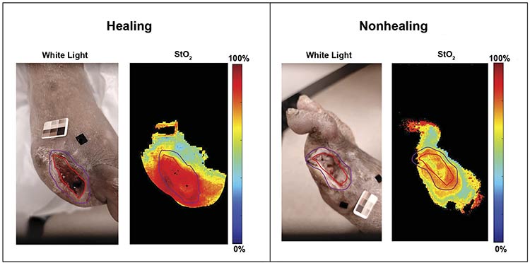 Figure 2. White light and oxygenation saturation maps (StO2) of healing and nonhealing post-debrided diabetic foot ulcer cases. The red and purple contour tracing is the clinician’s traced wound and peri-wound boundary, respectively. Courtesy of Florida International University.