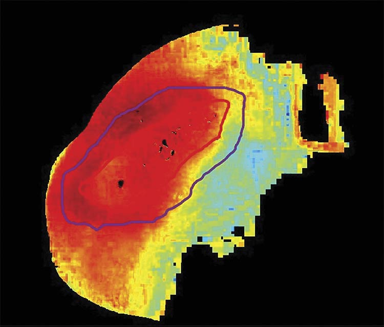 An oxygenation saturation map (StO2) of a healing post-debrided diabetic foot ulcer. Courtesy of Florida International University.