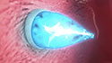 UV Catheter Plugs Holes in Hearts